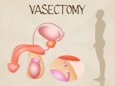 Vasectomia